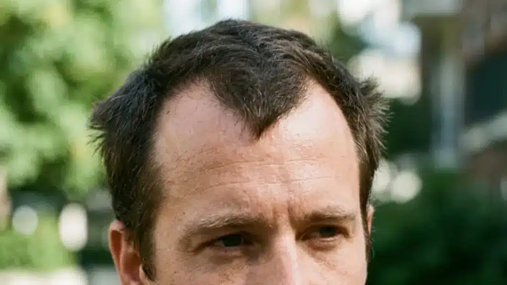 A man's forehead and dark hair show an M hairline against a blurred green outdoor background