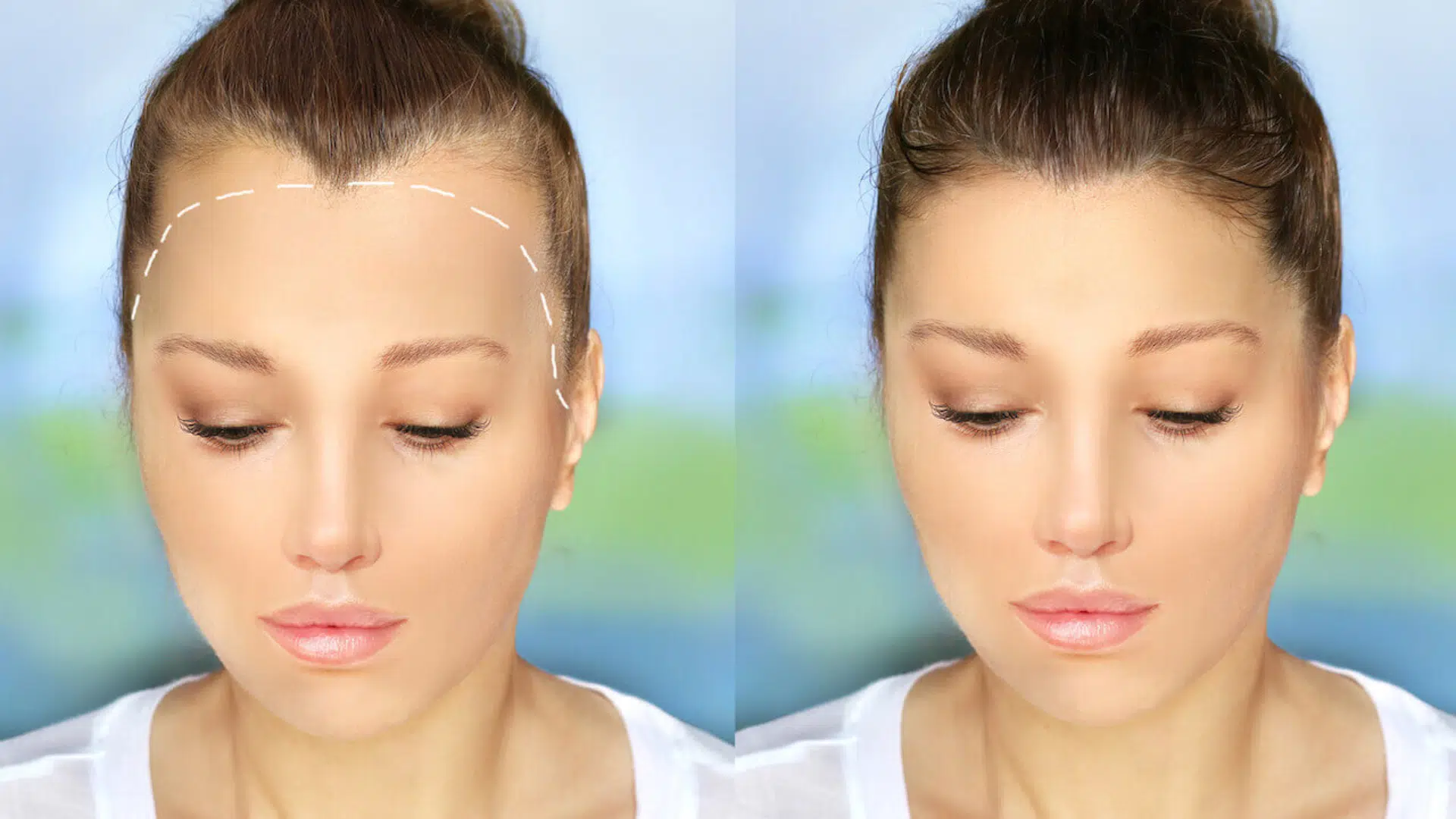 Case 1 High Hairline Correction