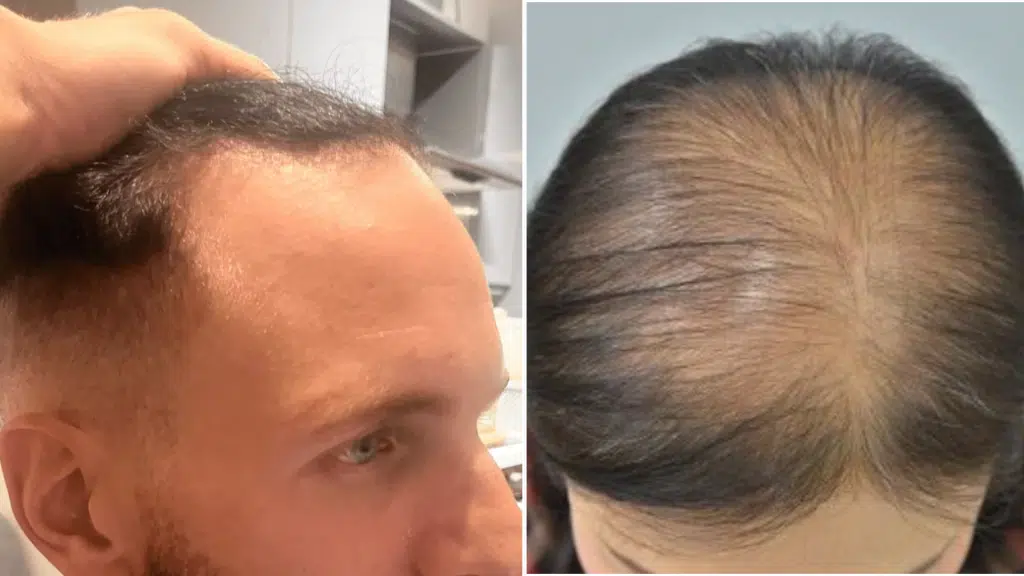 Effective Ways to Prevent a Receding Hairline