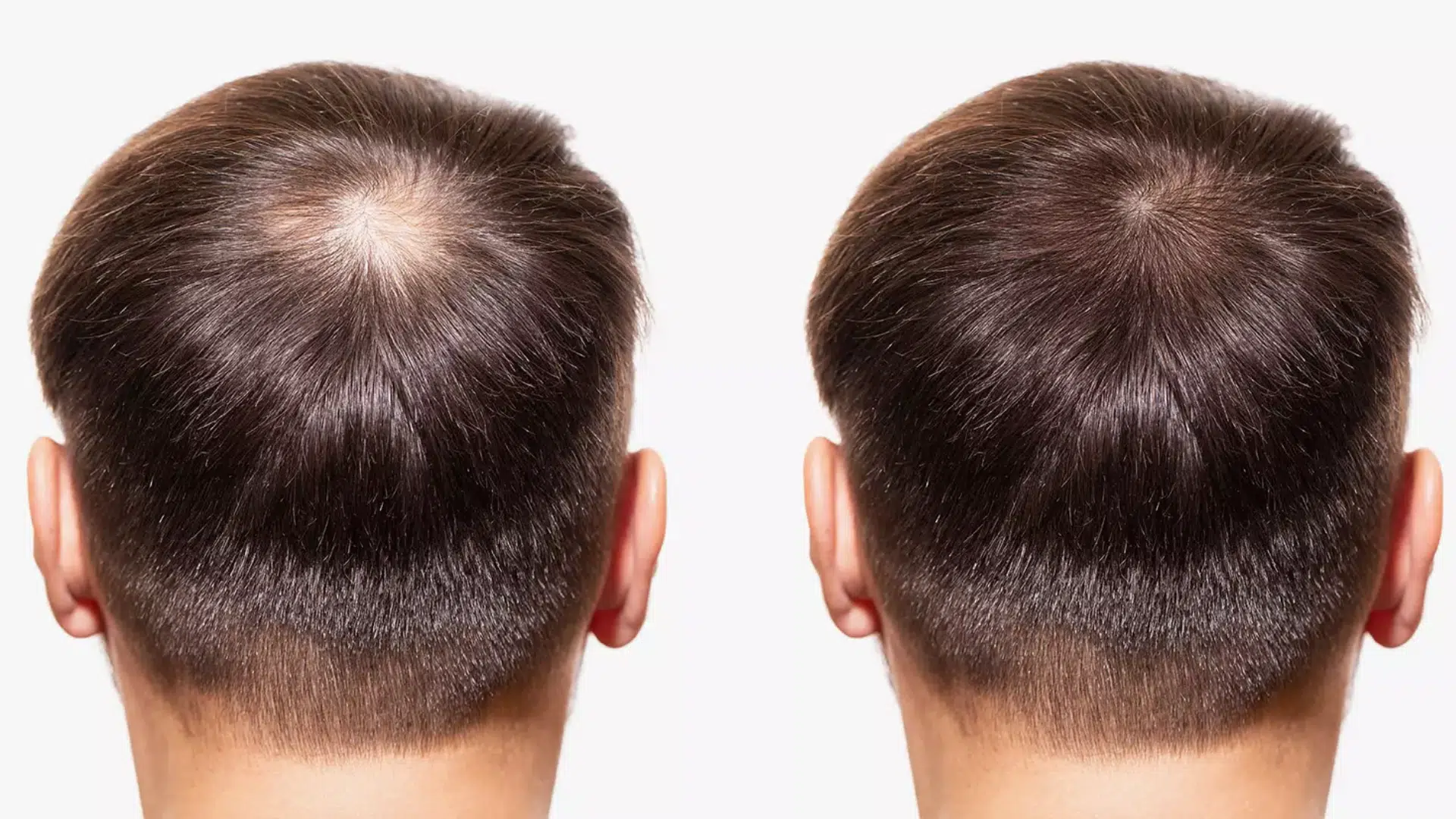 Effectiveness and Success Rates of Stem Cell Hair Restoration