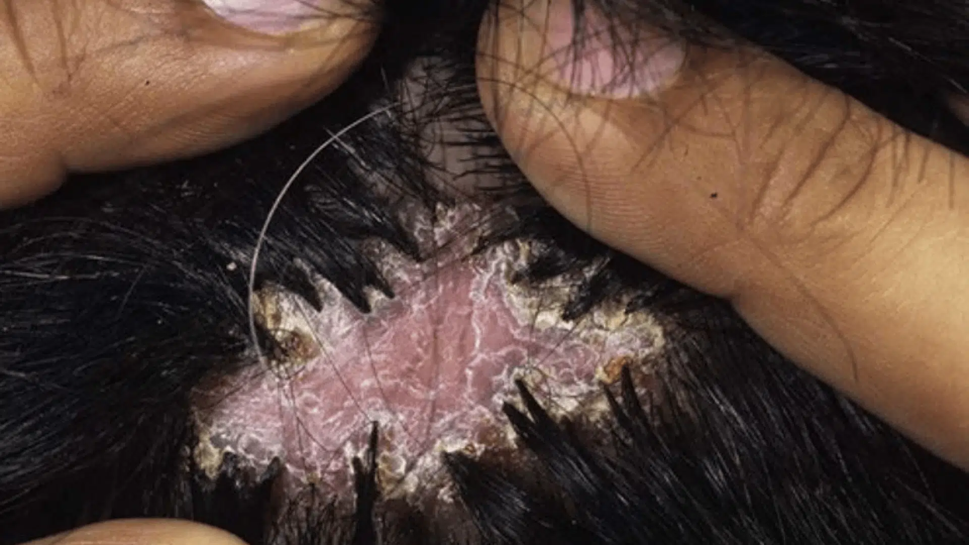 Folliculitis-Decalvans