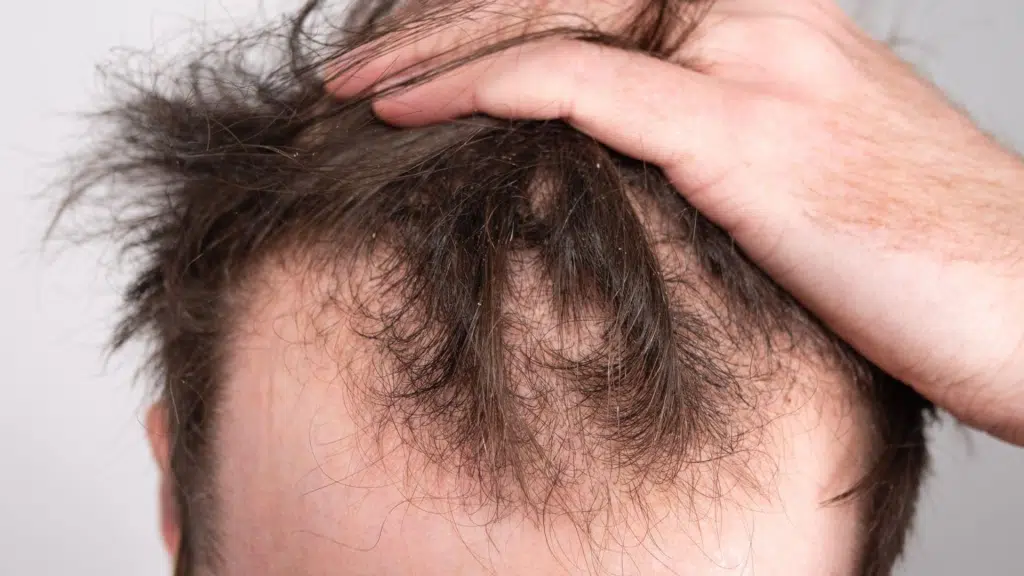 How+to+Identify+Signs+of+New+Hair+Growth+on+Scalp