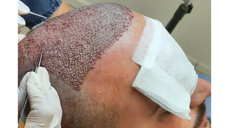 Is a Hair Transplant Painful? What to Expect