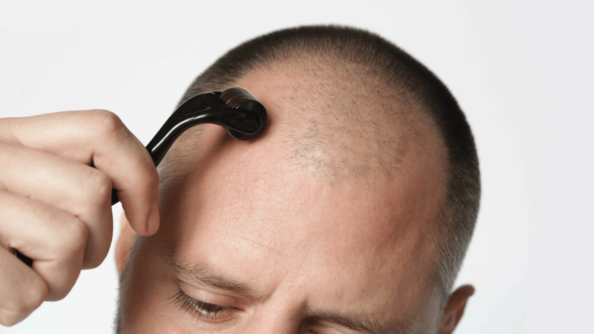 Microneedling