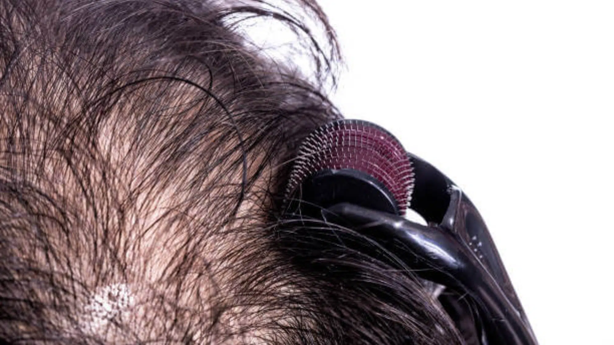 Treatments and Other Medications to Combine with Finasteride