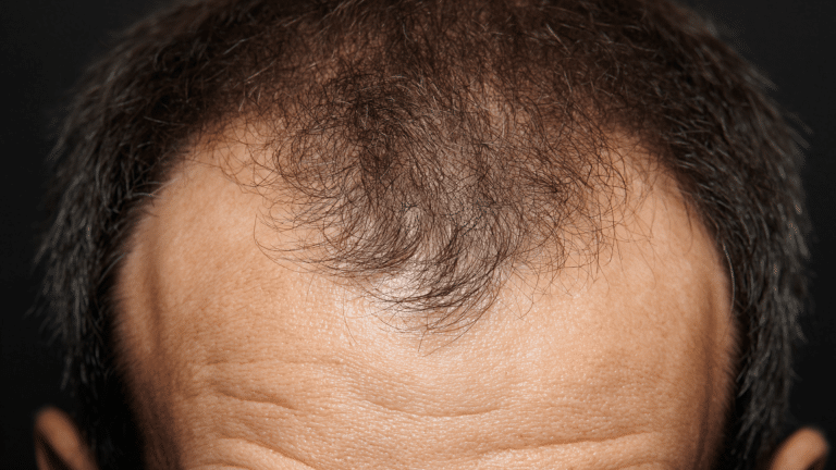 What Is an M Hairline and Why Is It Popular?