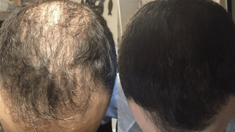 benefits-prf-hair-restoration-know