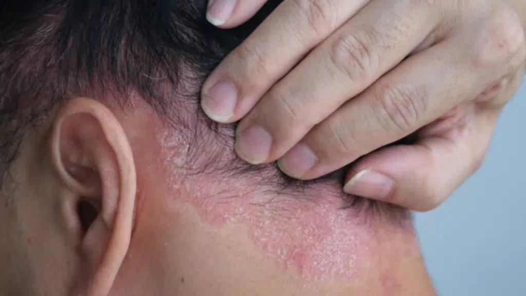 can-eczema-cause-hair-loss-what-you-need-to-know