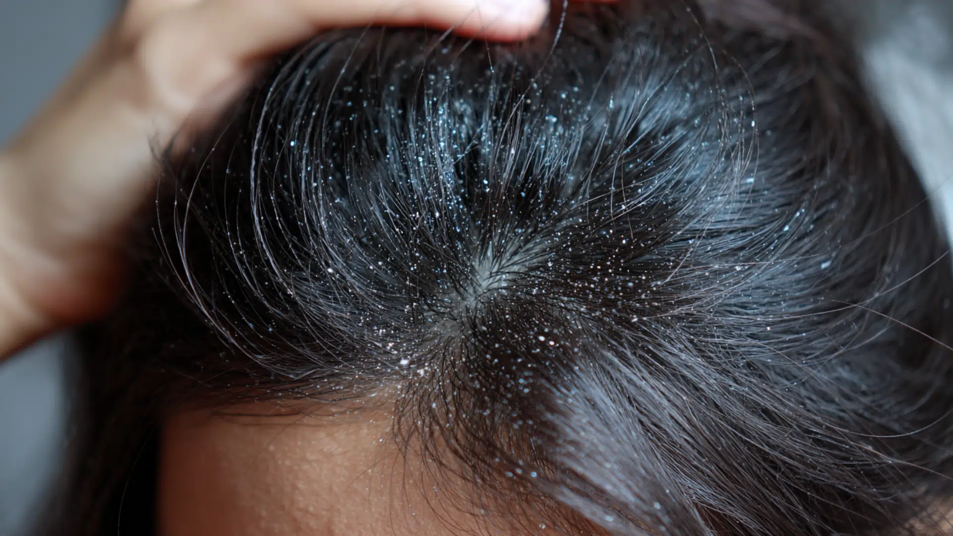 dandruff-prone-scalp