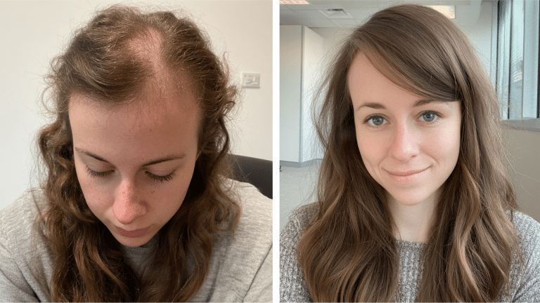 female-hair-transplant+(1)