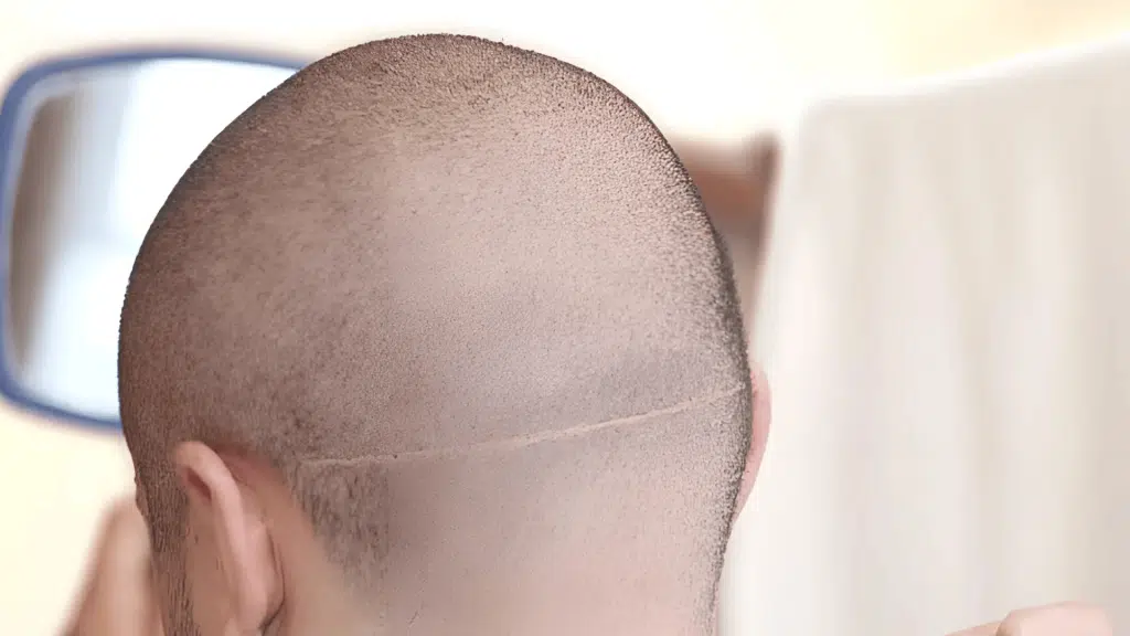 hair-transplant-scar