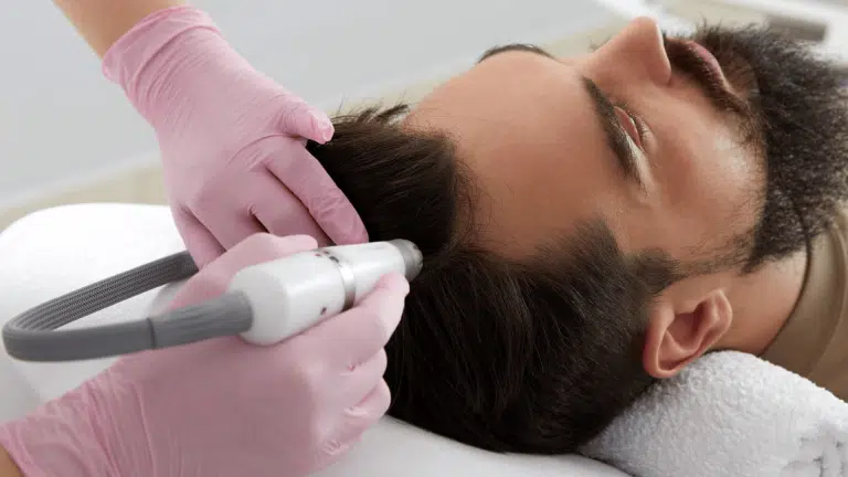 non-surgical-hair-transplant