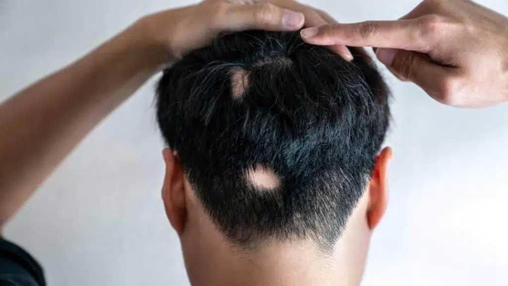 positional-alopecia
