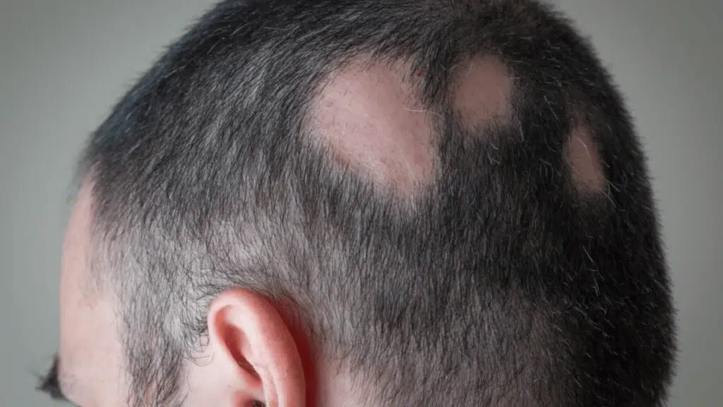 _scarring-alopecia-treatment