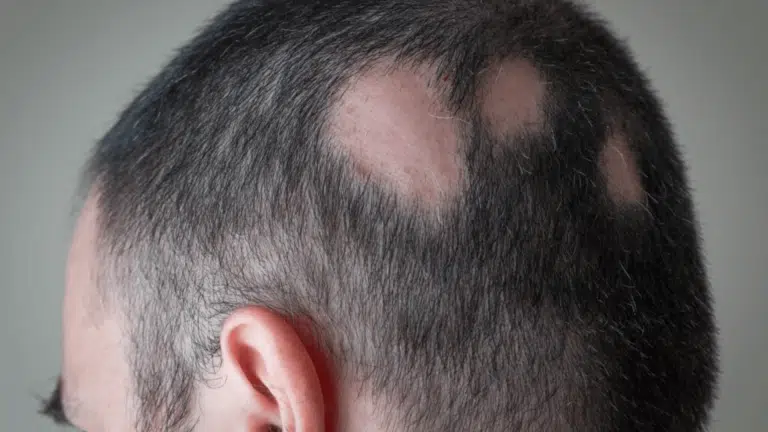_scarring-alopecia-treatment