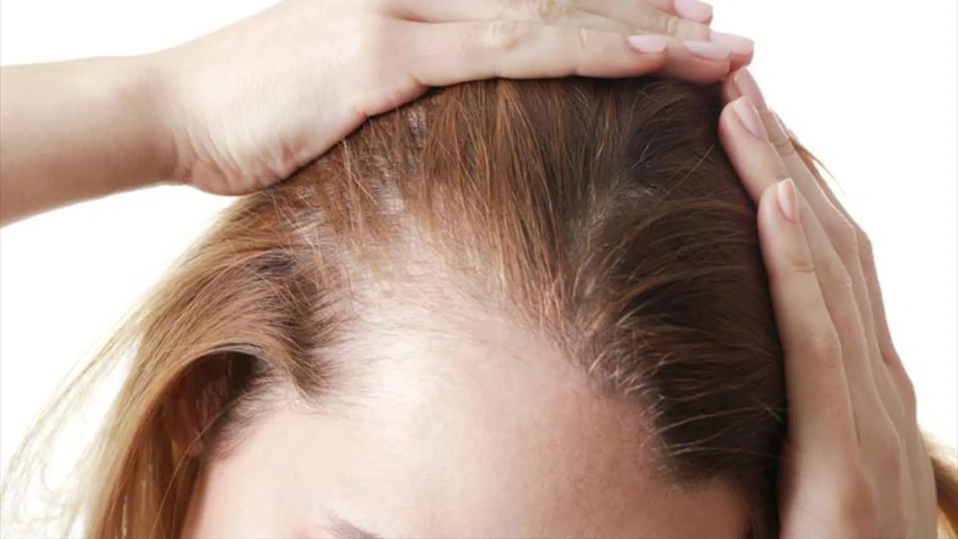 symptoms-of-hairline-receding-on-one-side