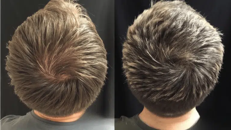 topical-finasteride-before-and-after