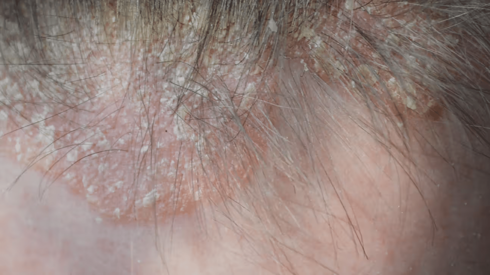what-causes-seborrheic-dermatitis