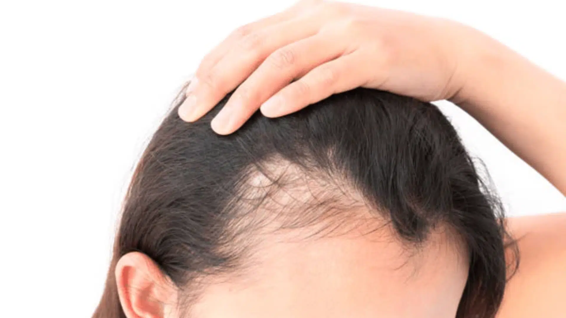 which-vitamin-deficiency-causes-hair-loss