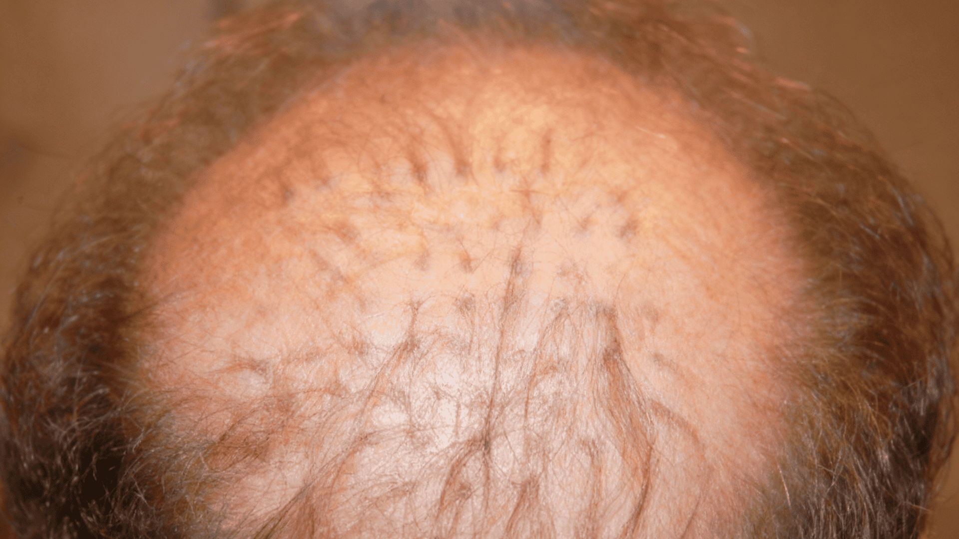 hair plugs the older approach