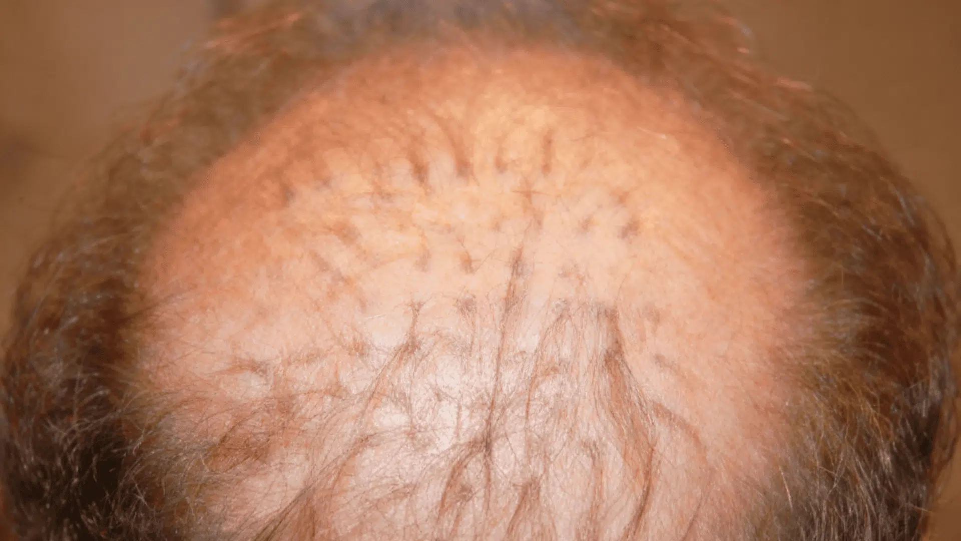 hair plugs the older approach