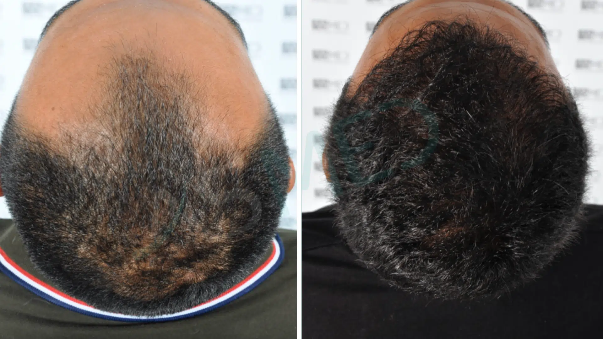 hair transplant recovery time fue technique