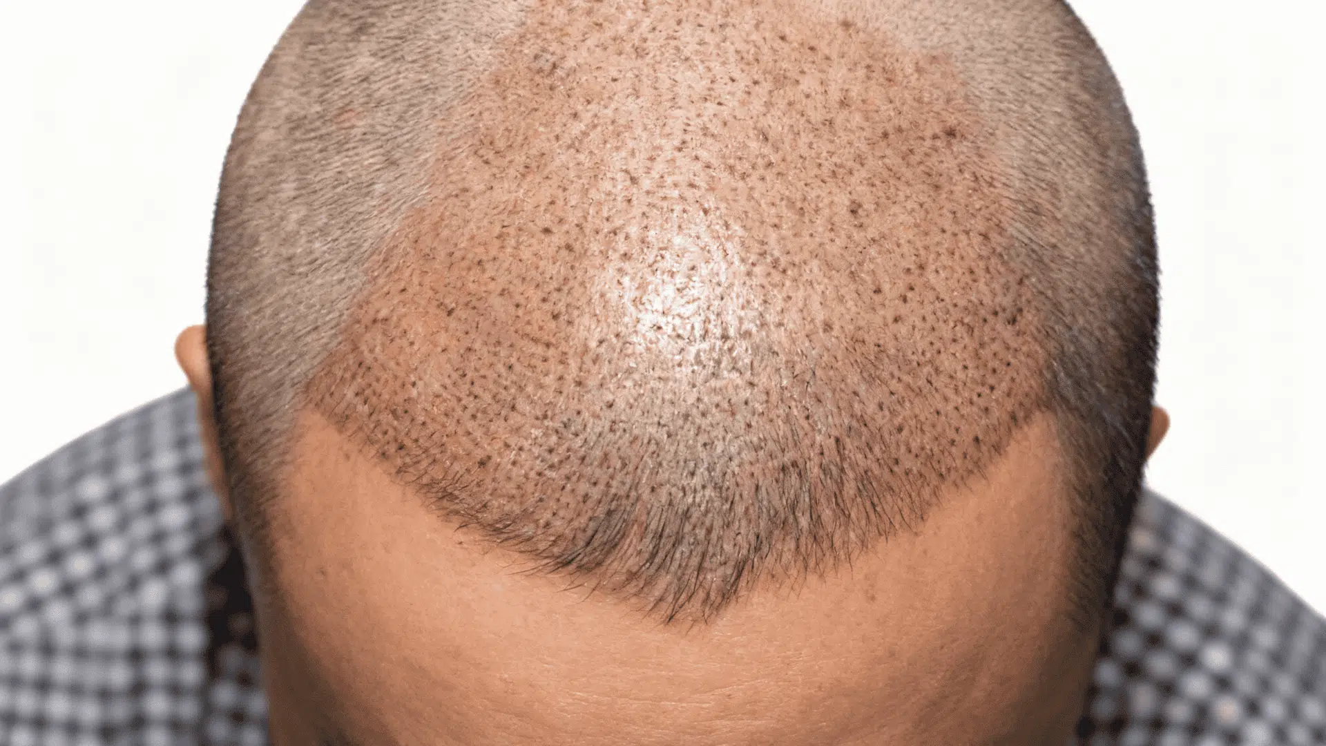 Hair Transplant - The Modern Solution
