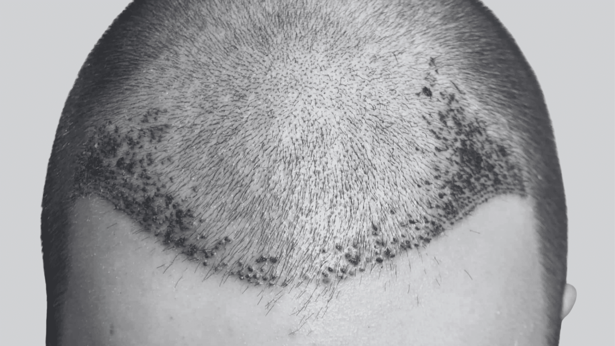 What is the Hair Transplant Recovery Time?