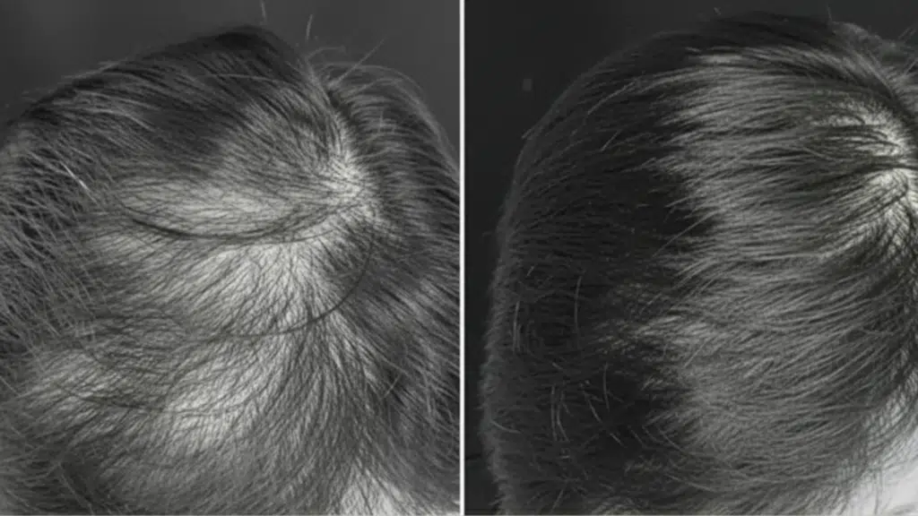 how effective is prp hair treatment before and after