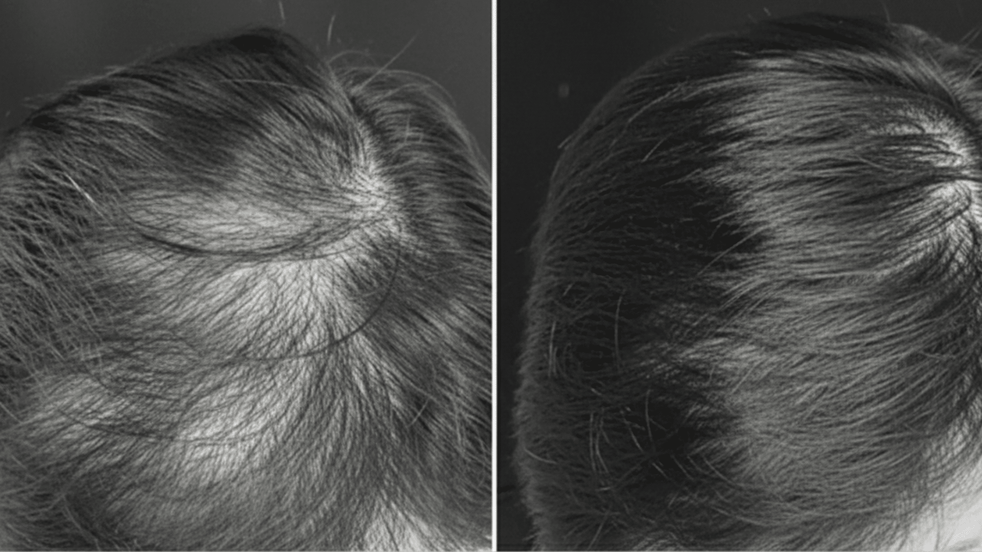 how effective is prp hair treatment before and after