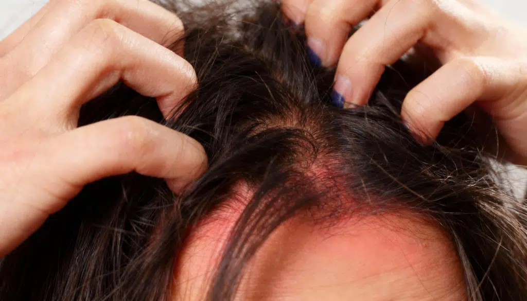 scalp-inflammation-causes-and-easy-ways-to-feel-better