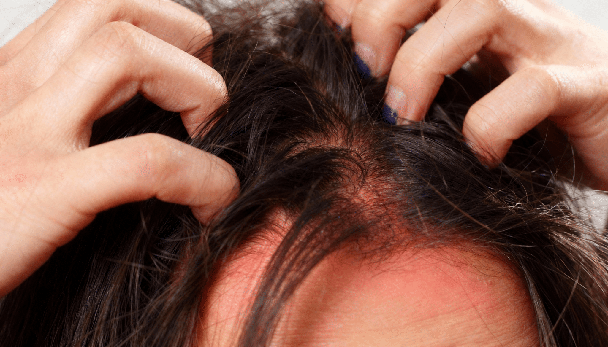 scalp-inflammation-causes-and-easy-ways-to-feel-better