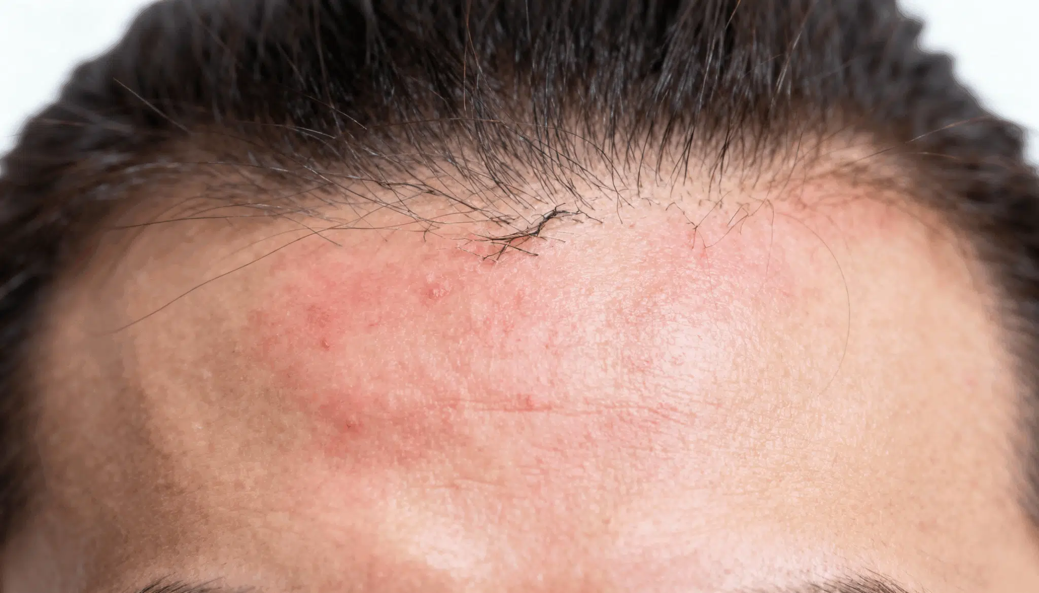 side effects of hair botox