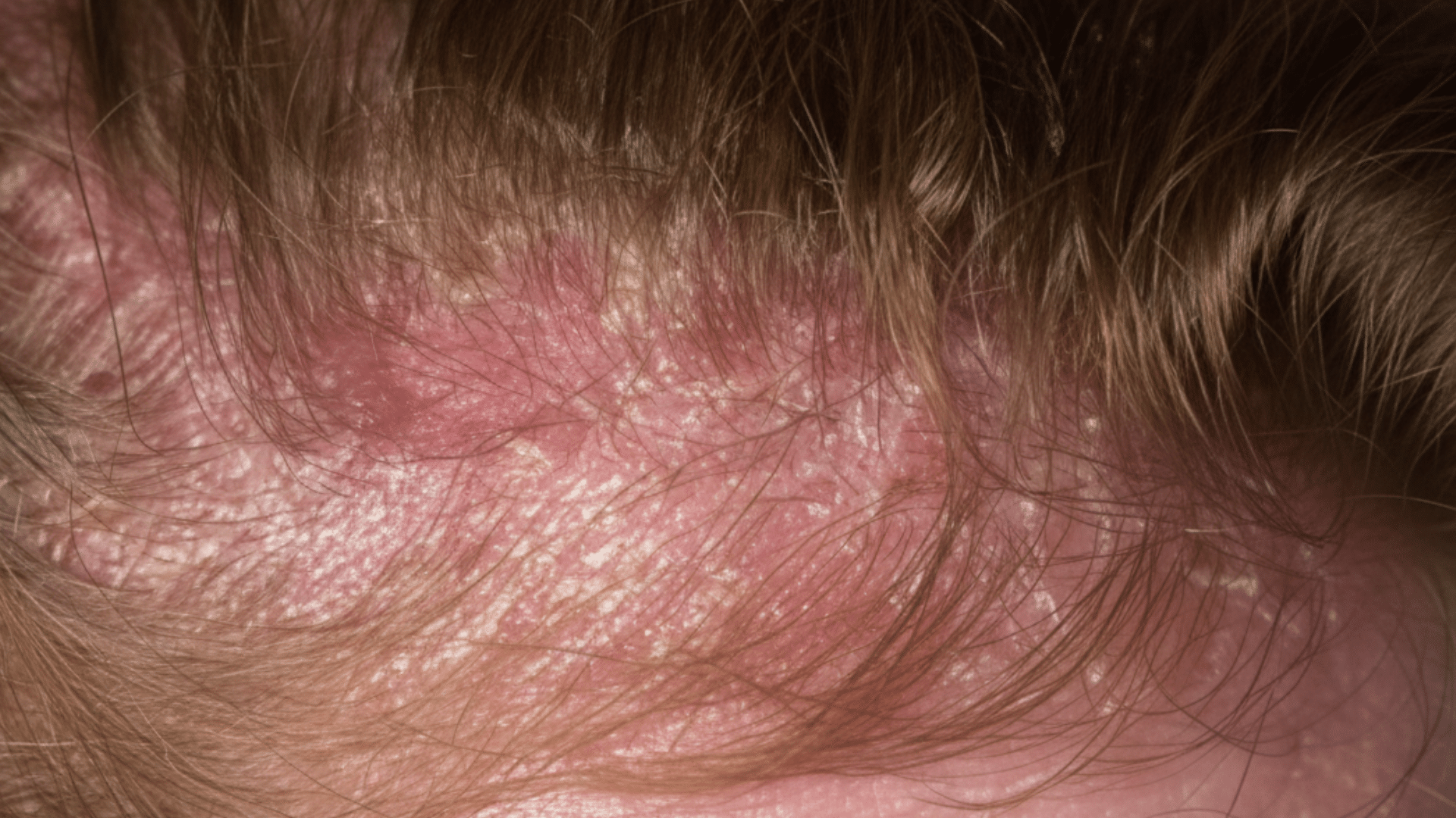 what-causes-scalp-inflammation
