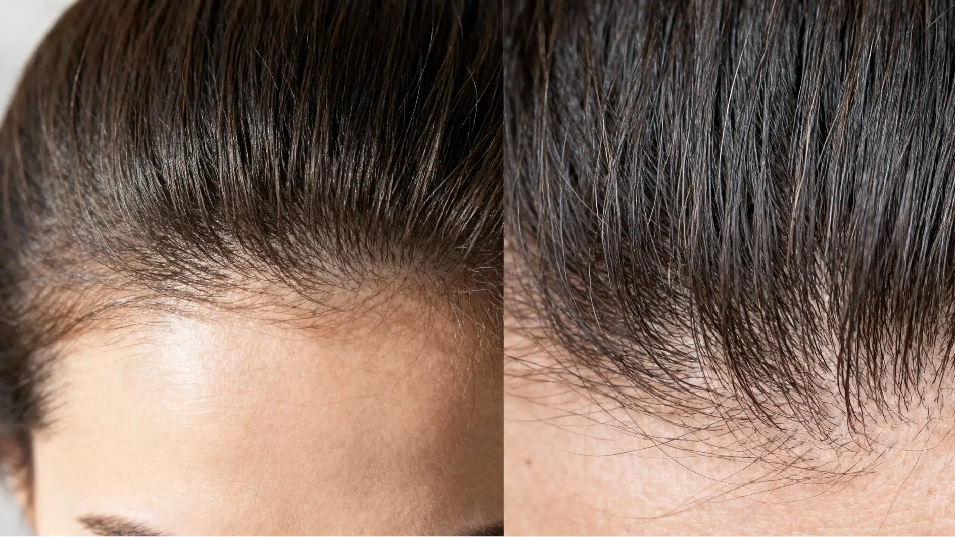 what mounjaro related hair loss usually looks like