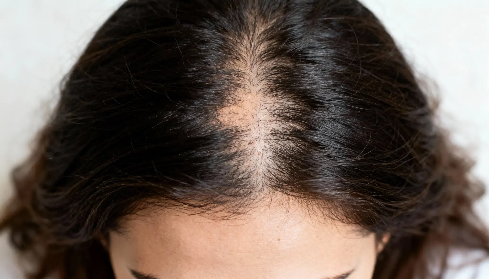 The Link Between PCOS and Hair Loss