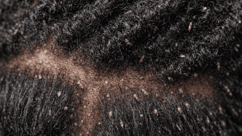 do-black-people-get-lice