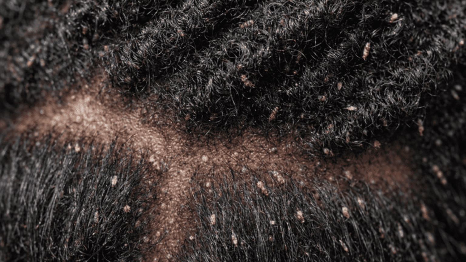 Can Black People Get Lice? Know the Facts Here - Stemsontx