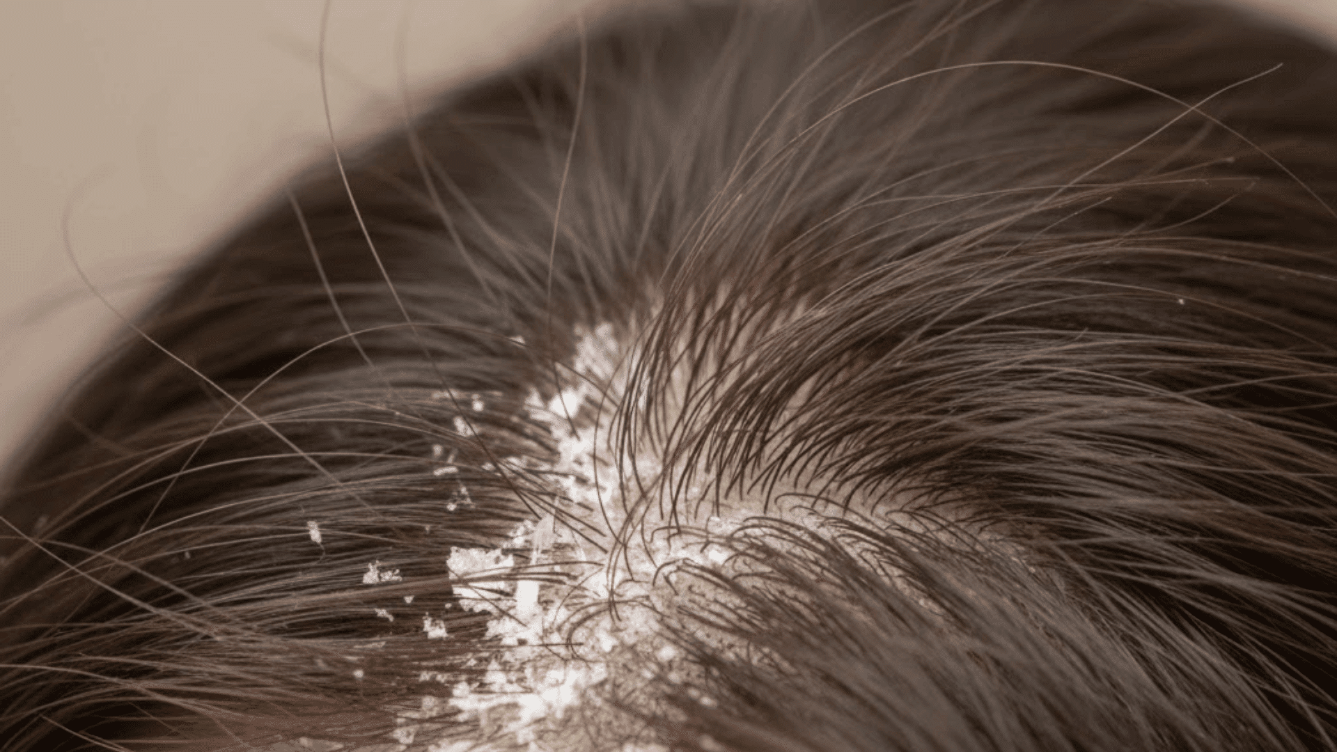 is salt good for hair dandruff