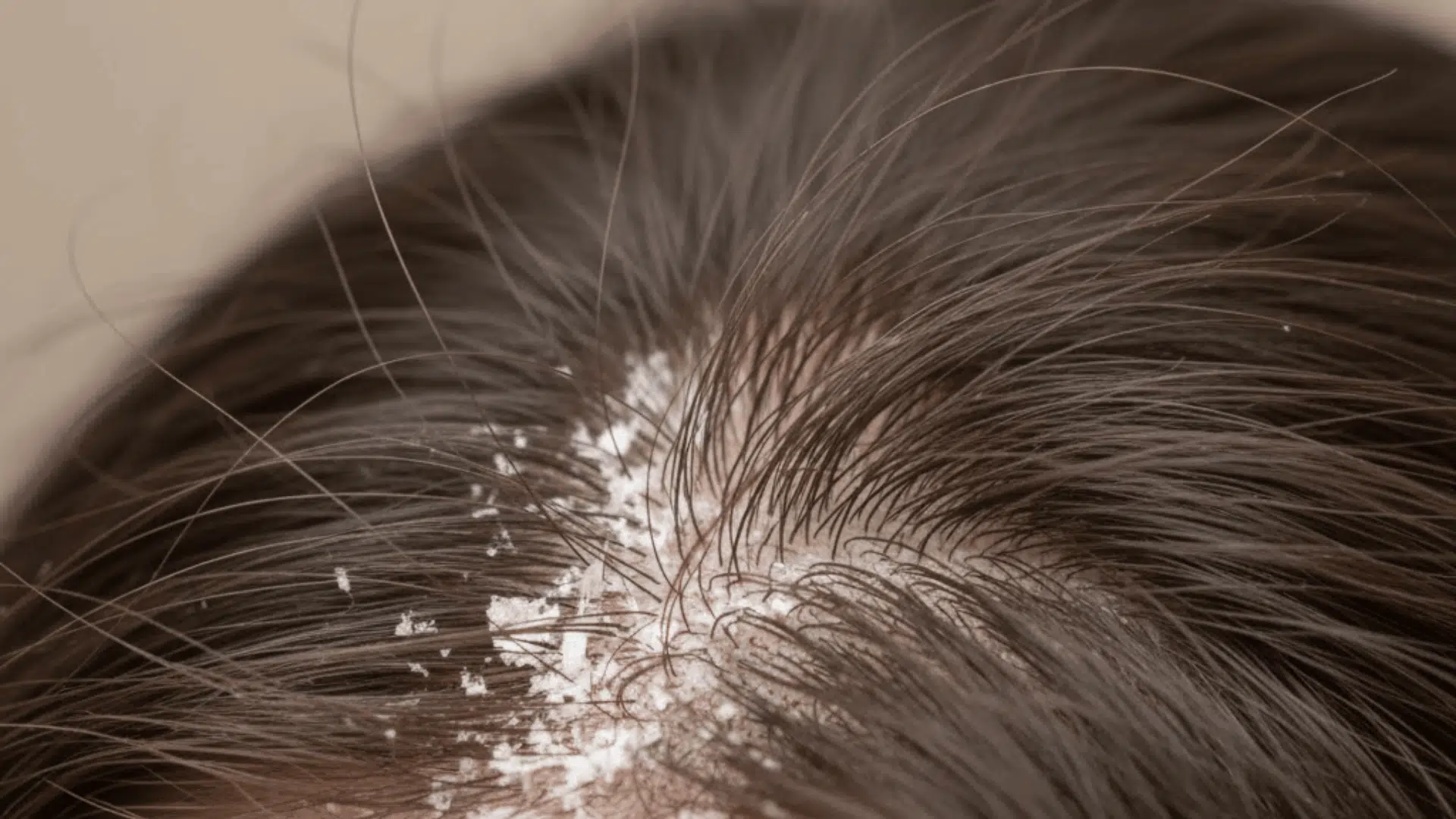 is salt good for hair dandruff