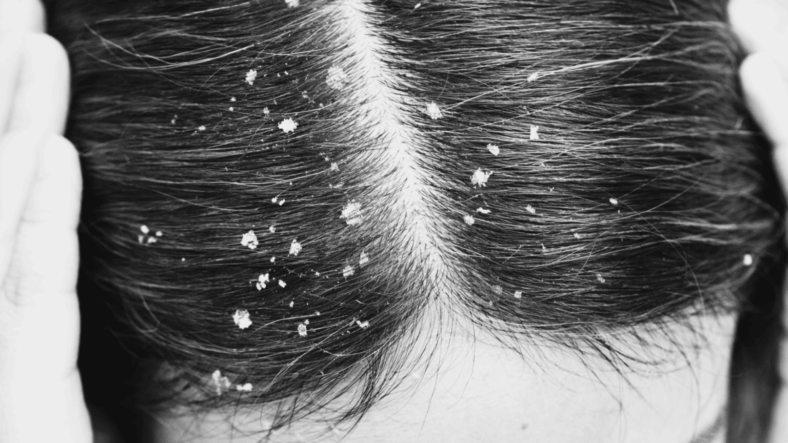 why do i have dandruff all of a sudden