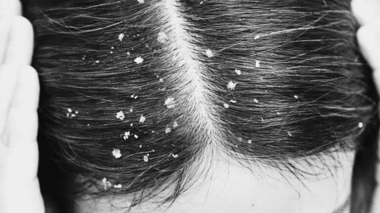 why do i have dandruff all of a sudden