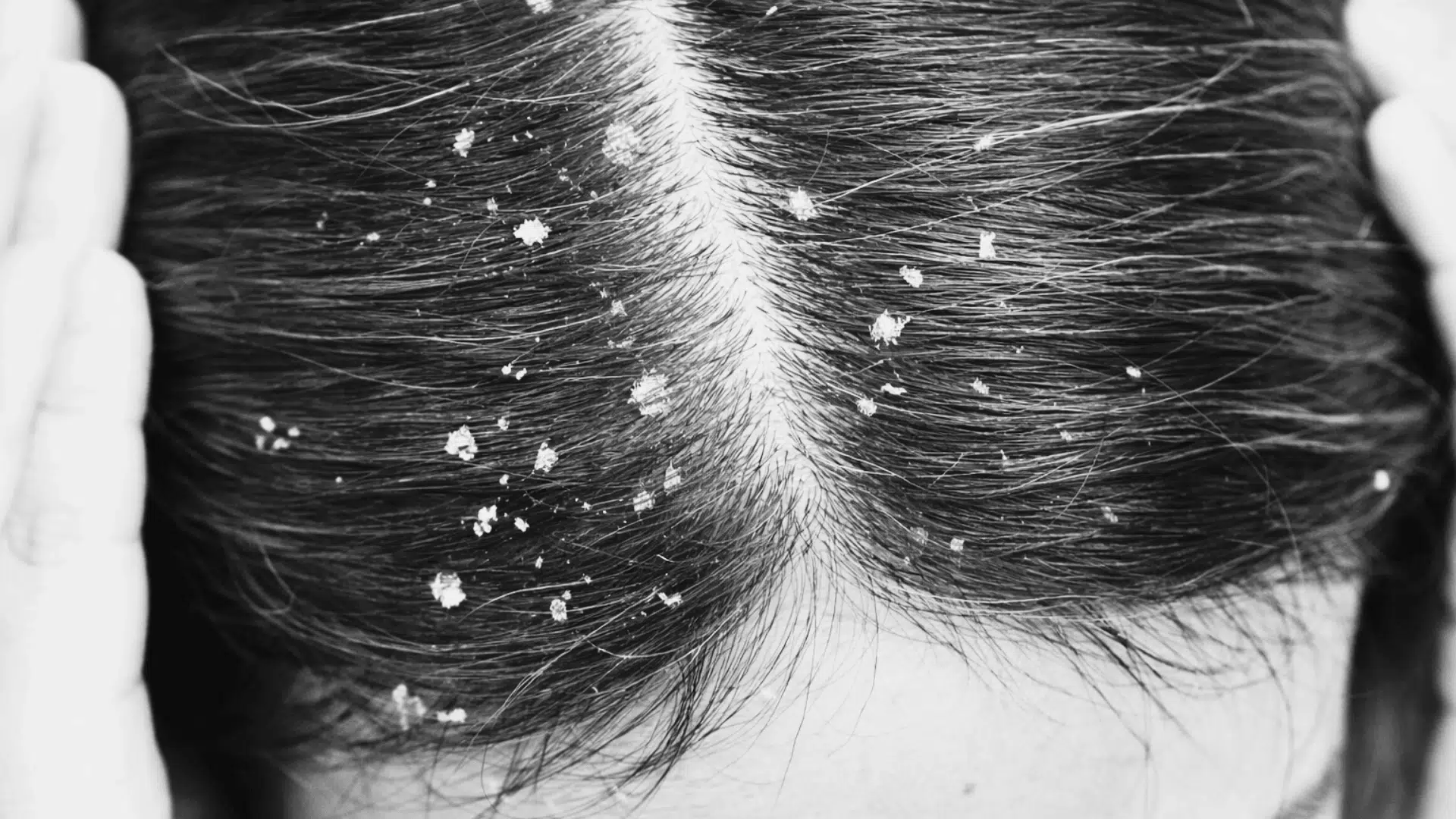 why do i have dandruff all of a sudden