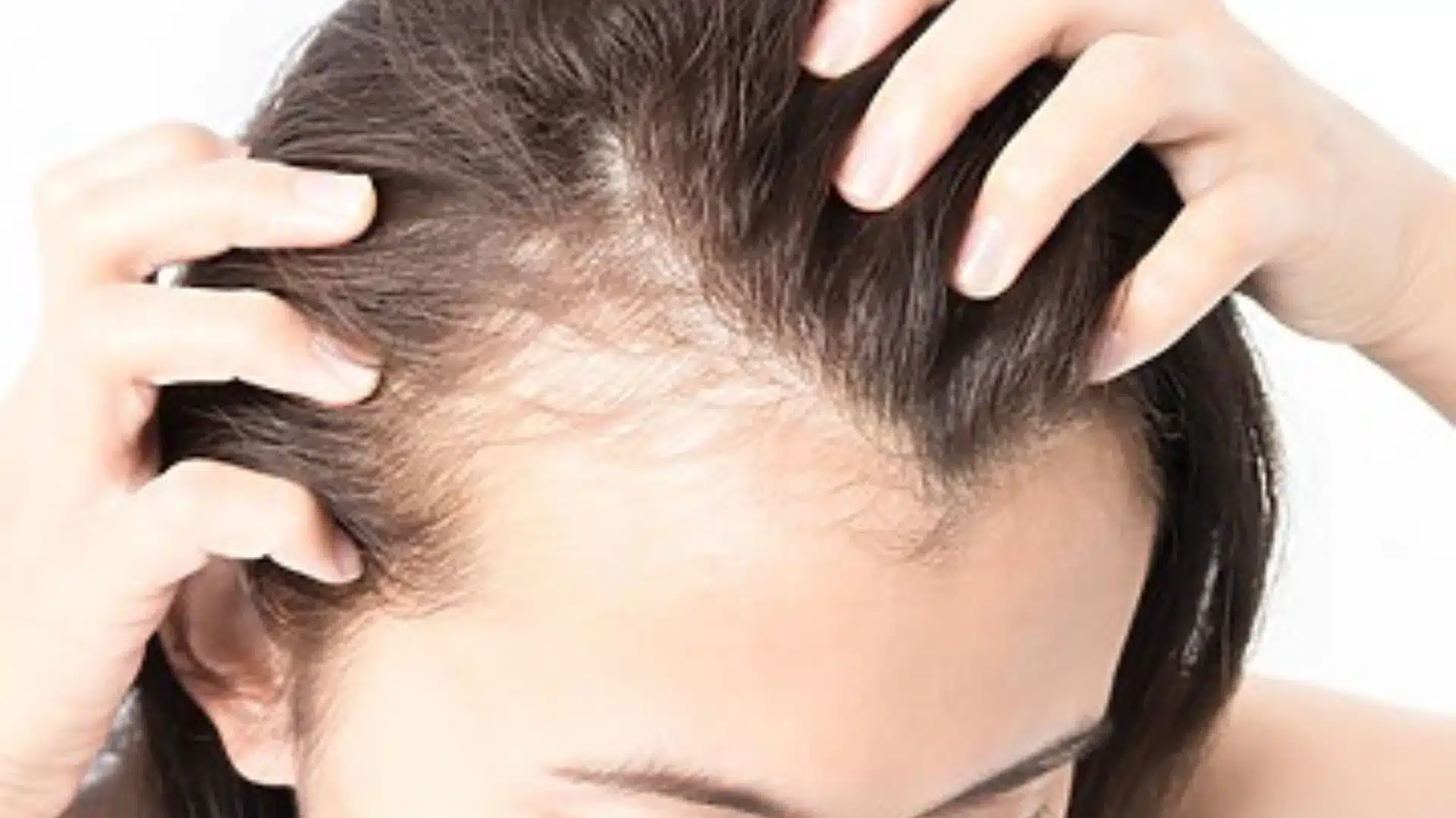Natural photo of a person with evenly thinning hair across the scalp due to hrt, visible scalp, soft indoor light, realistic appearance