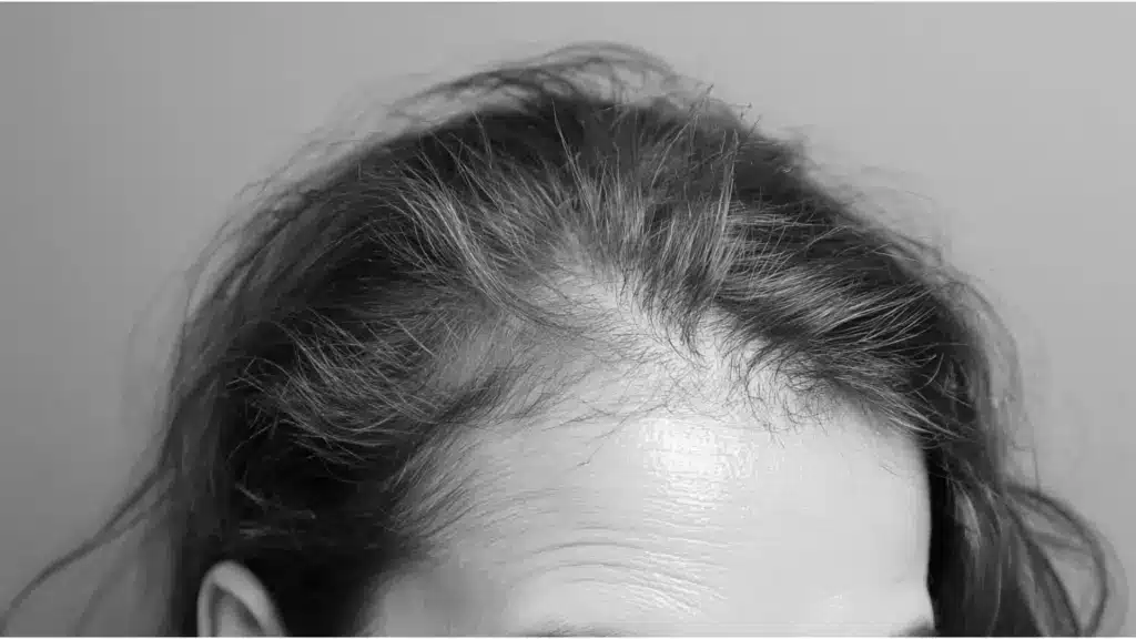 A black and white photo of a woman with noticeable hair thinning and a bald spot on her head.