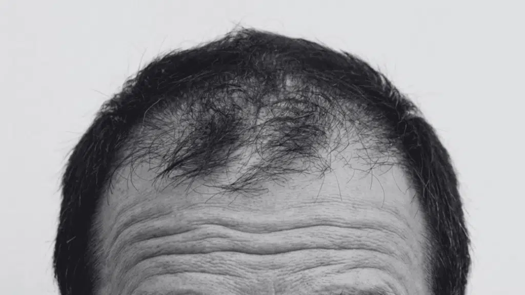 Black and white close-up of a man's receding hairline and wrinkled forehead against a light background.