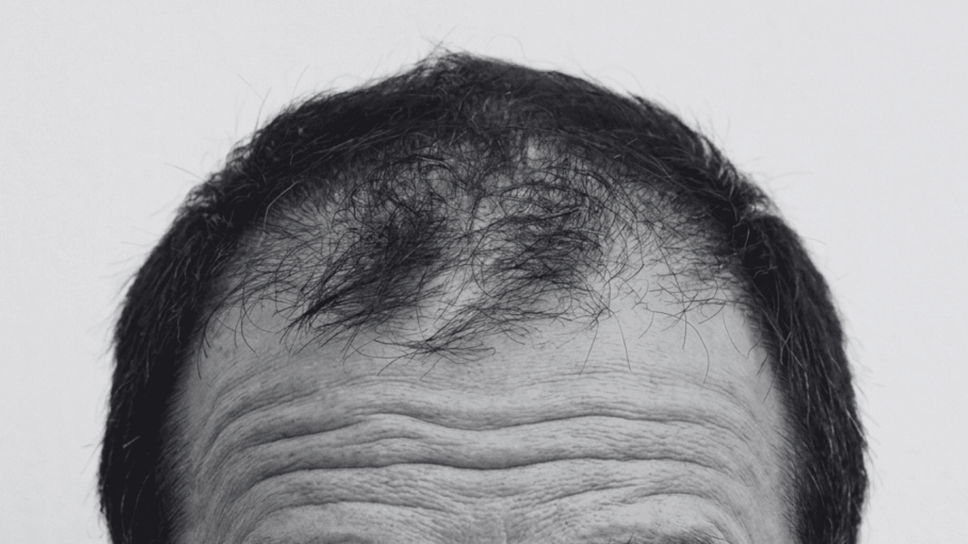 Black and white close-up of a man's receding hairline and wrinkled forehead against a light background.