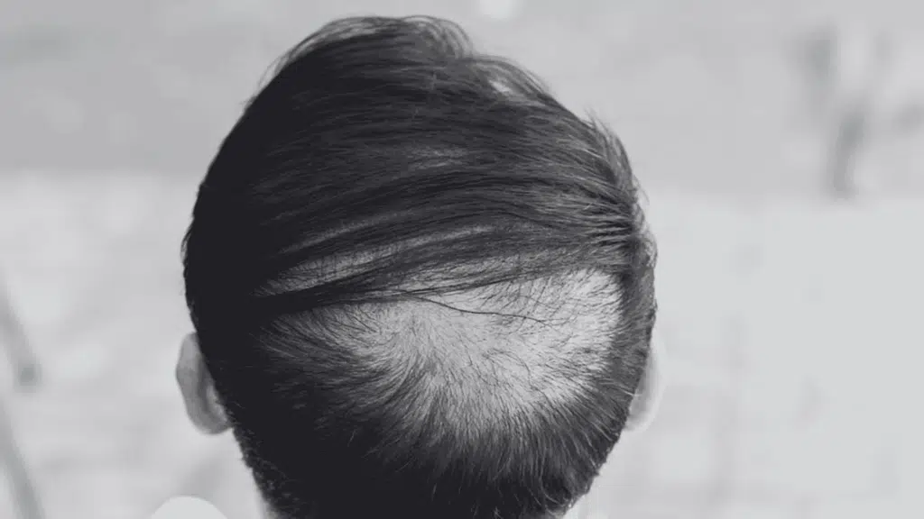 Close-up view from behind of a person's dark hair showing a noticeable area of thinning or balding on the crown
