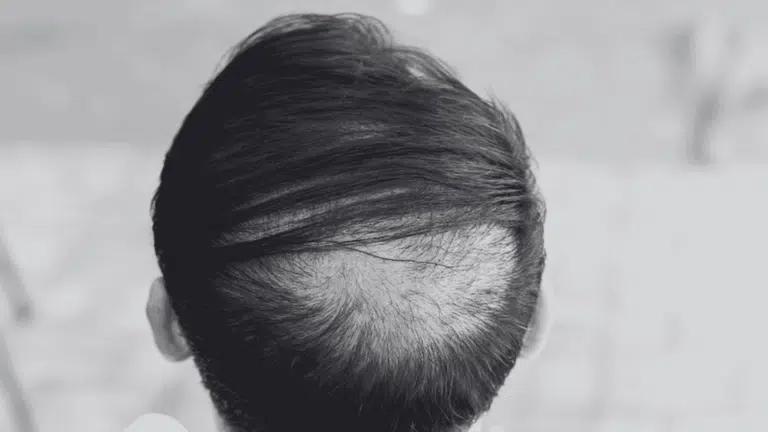 Close-up view from behind of a person's dark hair showing a noticeable area of thinning or balding on the crown