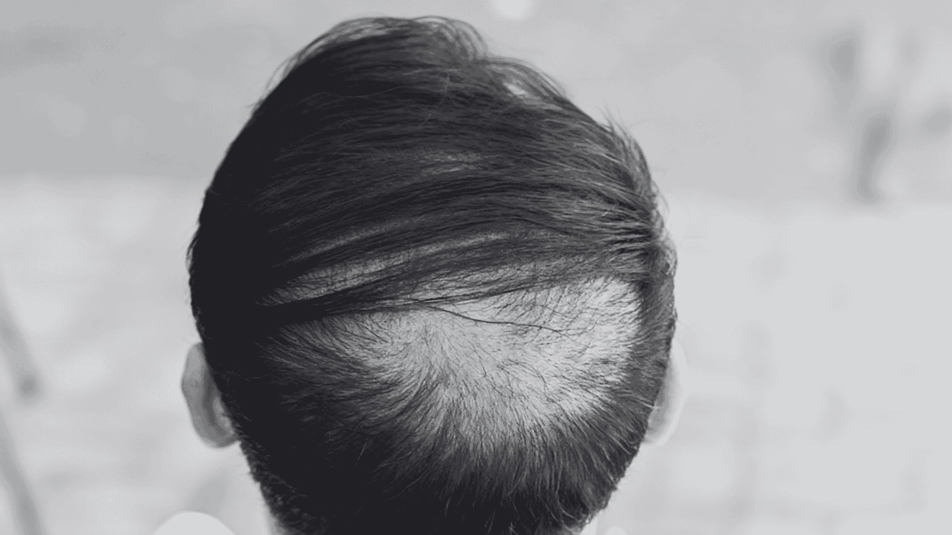 Close-up view from behind of a person's dark hair showing a noticeable area of thinning or balding on the crown
